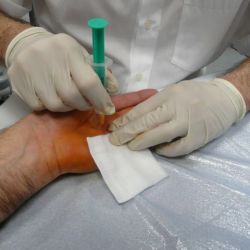 Nadelfasziotomie-Dupuytren1