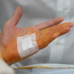 Nadelfasziotomie-Dupuytren2